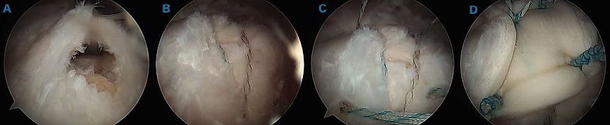 Arthroscopic revision rotator cuff repair